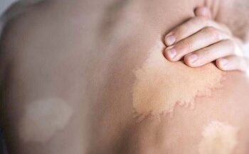 Maceió Registra Maior Número de Casos de Hanseníase em Cinco Anos: Aumento de 18% em 2023