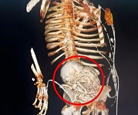‘Bebê de pedra’: idosa de 81 anos descobre feto calcificado que carregou por mais de 5 décadas