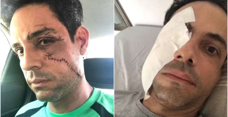 Empresário recebe 62 pontos no rosto após agressão em festa particular de condomínio e pode perder a visão