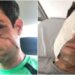 Empresário recebe 62 pontos no rosto após agressão em festa particular de condomínio e pode perder a visão