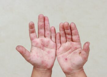 Santa Casa de Maceió alerta pais sobre a síndrome Mão-Pé-Boca