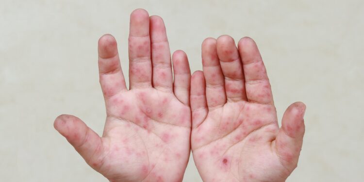 Santa Casa de Maceió alerta pais sobre a síndrome Mão-Pé-Boca