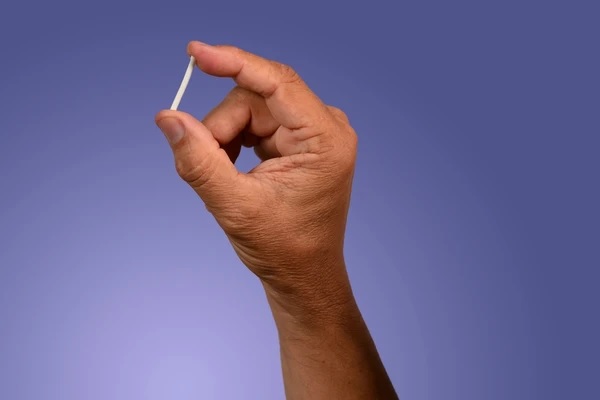 Implante contraceptivo hormonal entra para o rol de procedimentos obrigatórios dos planos de saúde, decide ANS