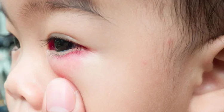 Inchaço matinal nas pálpebras de crianças pode indicar problema nos rins, alertam especialistas