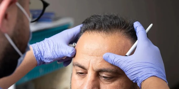 Transplante capilar: confira 5 perguntas para entender o procedimento