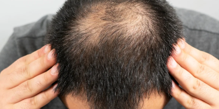 Finasterida e suicídio: relação de remédio de calvície e saúde mental foi ignorada por 20 anos, diz estudo