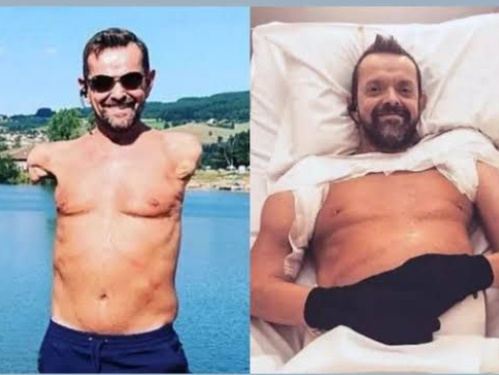 França realiza transplante duplo de braços e ombros e paciente recupera quase todos os movimentos