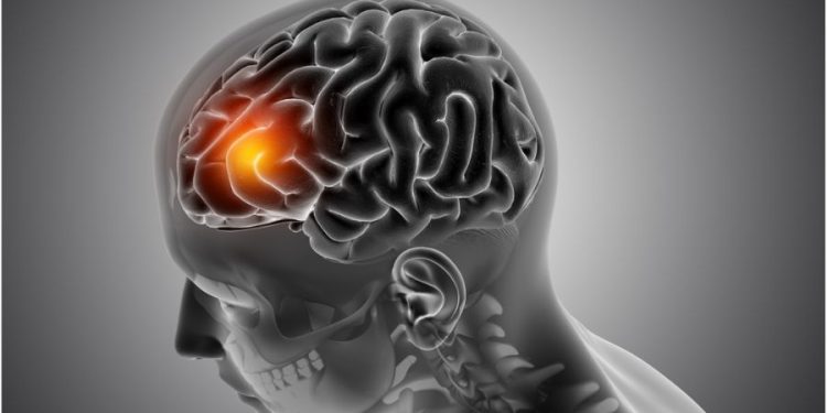 A cada seis minutos, uma pessoa morre de AVC no Brasil, alertam especialistas