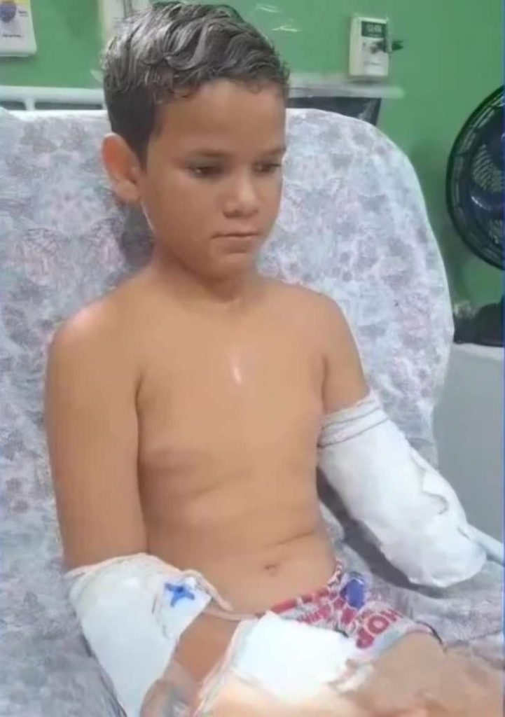 Menino de 10 anos sofre amputação parcial do braço após acidente na BR-316